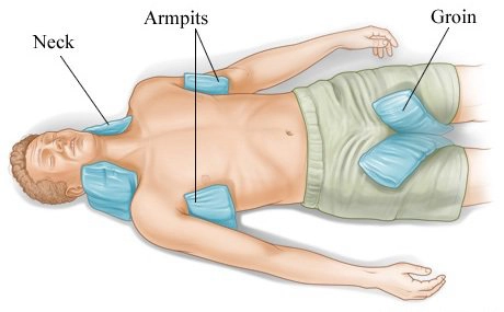 Đắp mát cho bệnh nhân nắng nóng bị đột quỵ