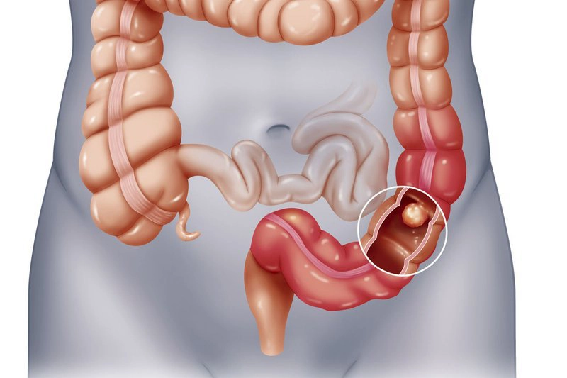 Cách để điều trị dứt điểm tắc ruột?
