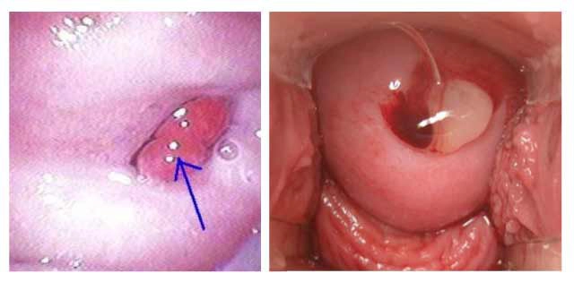 Polyp cổ tử cung