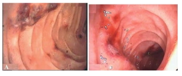 Hình ảnh nội soi ban xuất huyết Henoch-Schonlein ở tá tràng