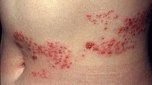 1Nhiễm hiv khi quan hệ tình dục khiến người bệnh mắc Zona thần kinh