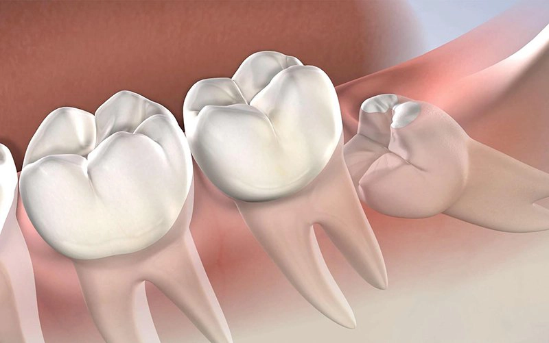 Khi xuất hiện tình trạng răng khôn mọc lệch bạn nên tới nha sĩ để được kiểm tra nhằm có hướng can thiệp kịp thời