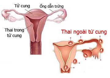 thai-ngoai-tu-cung -1