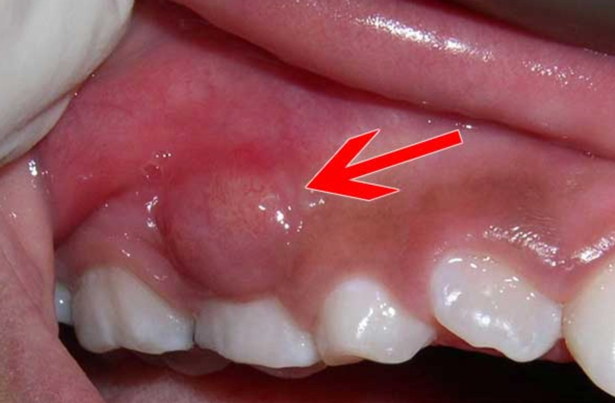 Nhiễm trùng chân răng có thể gây đau răng và khó chịu cho người bệnh