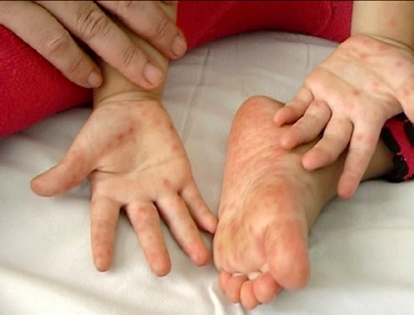 Số ca tay chân miệng gia tăng