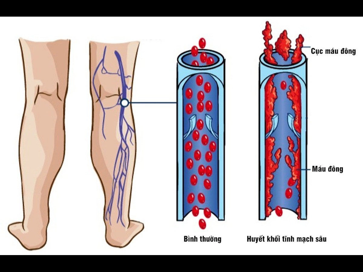 Bệnh DVT