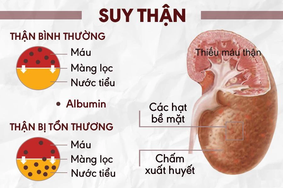 Suy thận mạn: Các phương pháp điều trị và hiệu quả