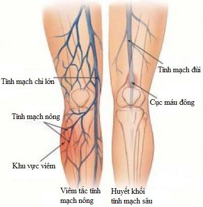 Huyết khối động mạch cấp tính