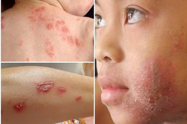 bị kiến ba khoang cắn