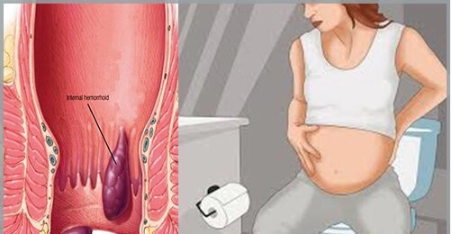 thai phụ bị bệnh trĩ khi đang mang thai