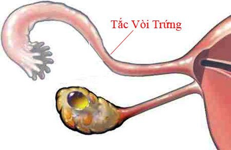 Tắc vòi trứng phải và trứng rụng bên phải thì trứng bên trái có phát triển không?