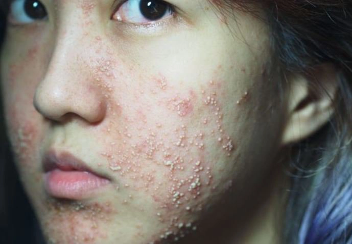 nguyên nhân da mặt bị ngứa