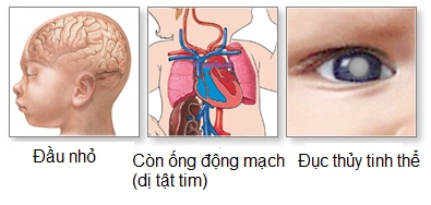 Một số bệnh do biến chứng Rubella gây ra.