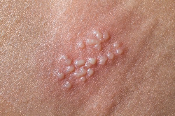 Khái niệm cơ bản về mụn rộp sinh dục