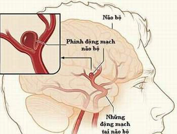 phình động mạch não