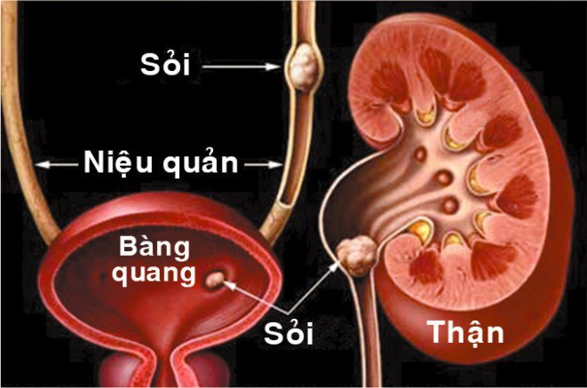 Thế nào là tán sỏi ngoài cơ thể?