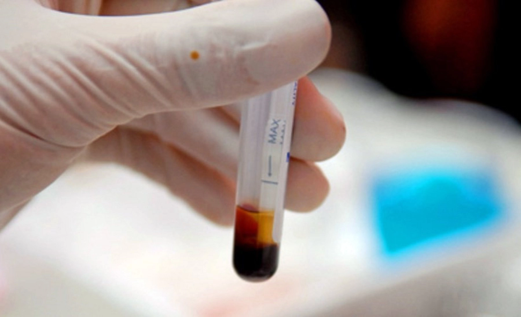 Xét nghiệm Adenosine Deaminase