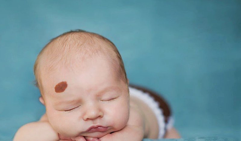 U mạch máu và tình trạng nổi cục u sau đầu có liên quan đến nhau