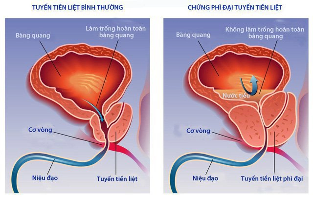 Thiếu kẽm kéo dài có thể là nguyên nhân gây phì đại tuyến tiền liệt