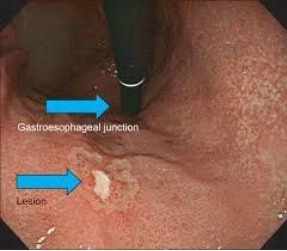 Hình ảnh ung thư sớm dạ dày