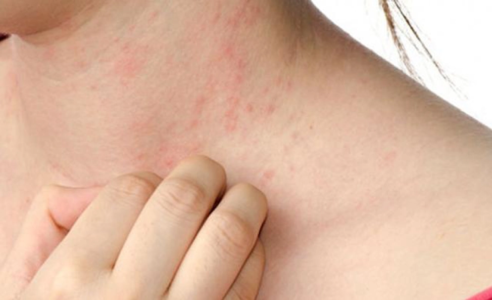 Dị ứng nước hoa có thể gây tình trạng viêm da tiếp xúc