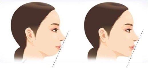Tiêm filler cằm
