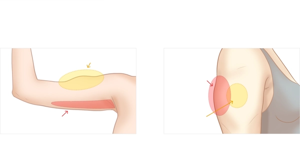 Tiêm thon gọn bắp tay giữ được bao lâu