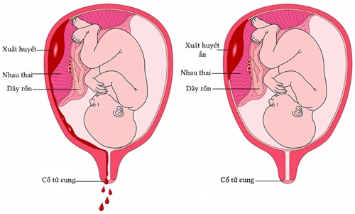 Rau bong non - tai biến sản khoa nguy hiểm