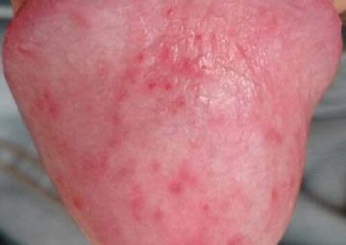 Mụn do viêm bao quy đầu
