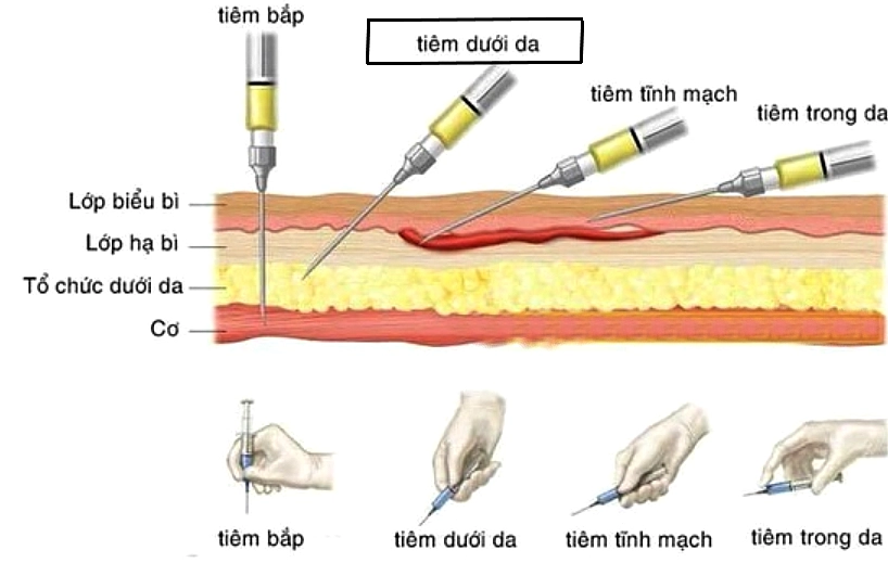 Kỹ thuật tiêm dưới da