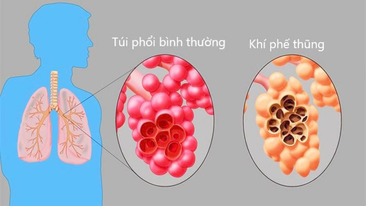 Khí phế thũng