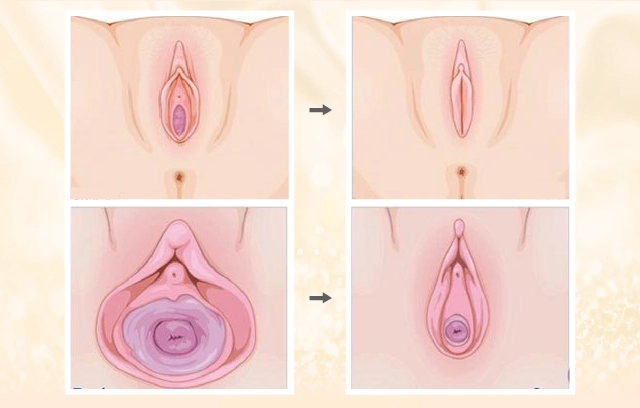 Dị dạng sinh dục nữ