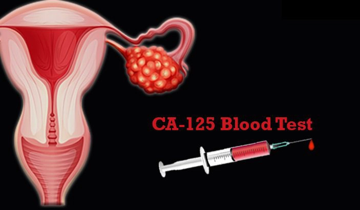 Chỉ số CA-125 bao nhiêu là bình thường