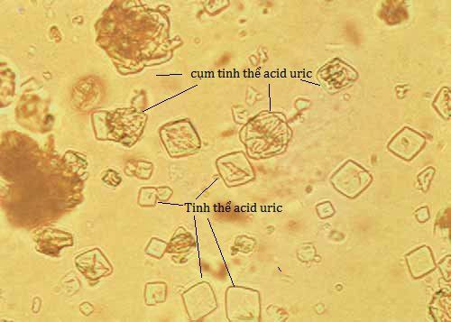 tinh thể nước tiểu