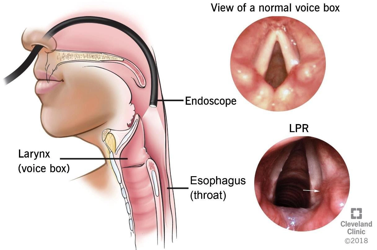 Các thành phần ở dạ dày có thể trào ngược lên thanh quản gây bệnh lý viêm thanh quản trào ngược