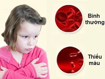trẻ bị thiếu máu có nguy hiểm không