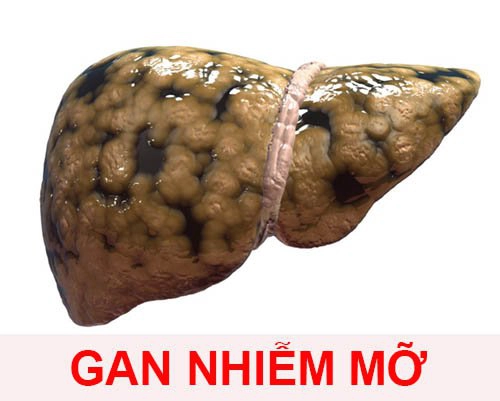 Gan nhiễm mỡ có mấy loại?
