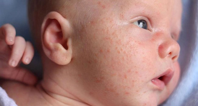 Tắm cho trẻ bị sốt virus