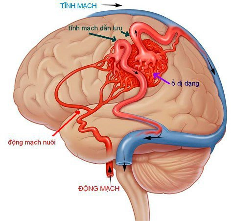 Mạch máu não dị dạng