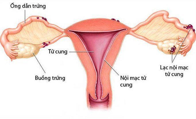 tu-cung-khong-phai-do-mang-thai-4