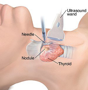 Chọc hút tế bào tuyến giáp