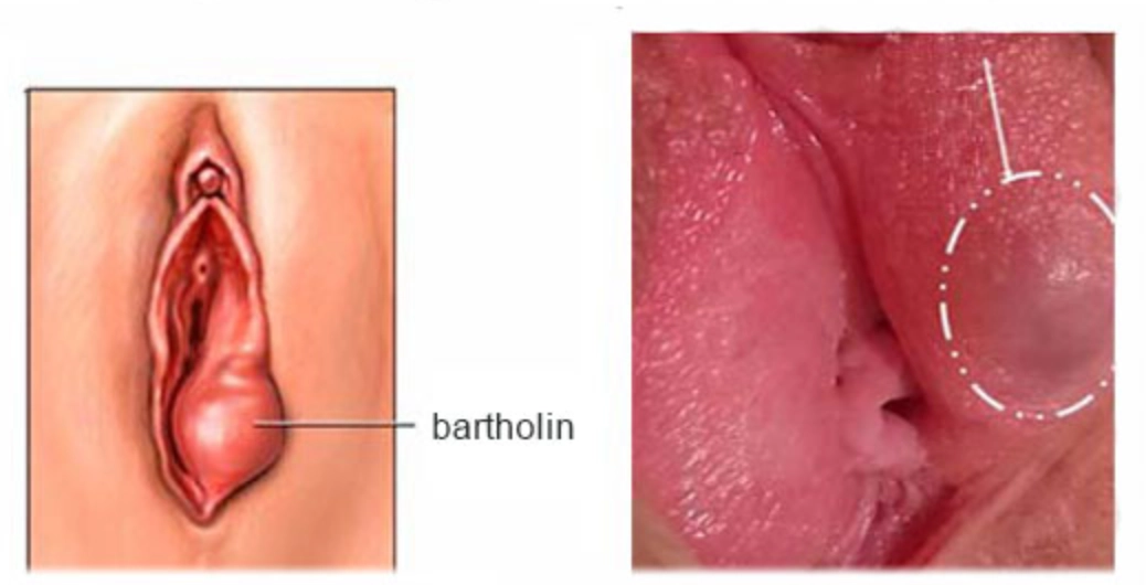 Nang tuyến Bartholin