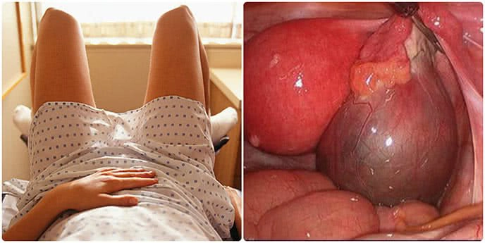 U nang buồng trứng và những ảnh hưởng tới sức khỏe sinh sản
