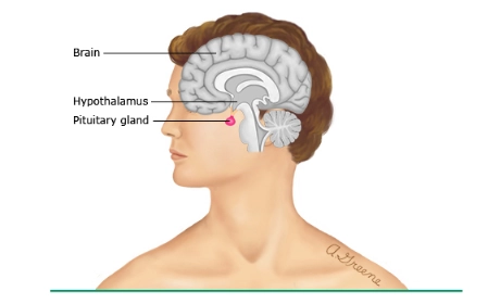 Bệnh u tuyến yên tăng tiết prolactin có các triệu chứng ở nam và nữ khác nhau