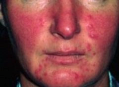 bệnh rosacea