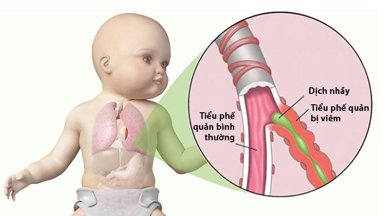 Viêm tiểu phế quản và những điều cần biết