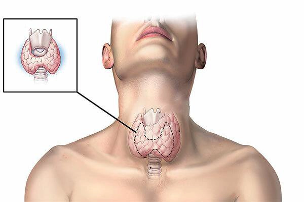 Ngườ bệnh mắc U tuyến giáp cần được giải phóng đường thở trong cấp cứu