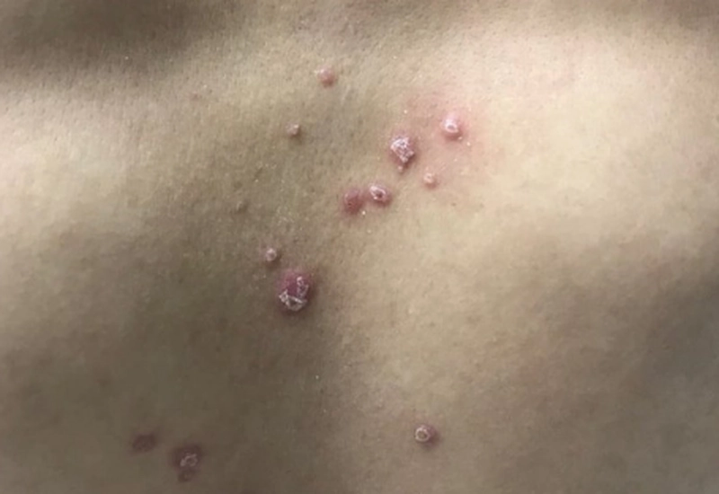 Các bệnh xã hội như bệnh giang mai có thể khiến bạn ngứa về đêm