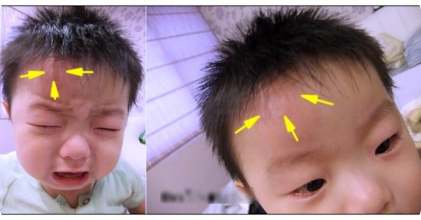 Trẻ ngã đập đầu