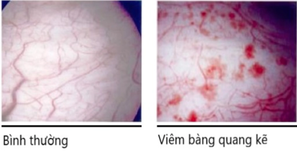 Viêm bàng quang kẽ